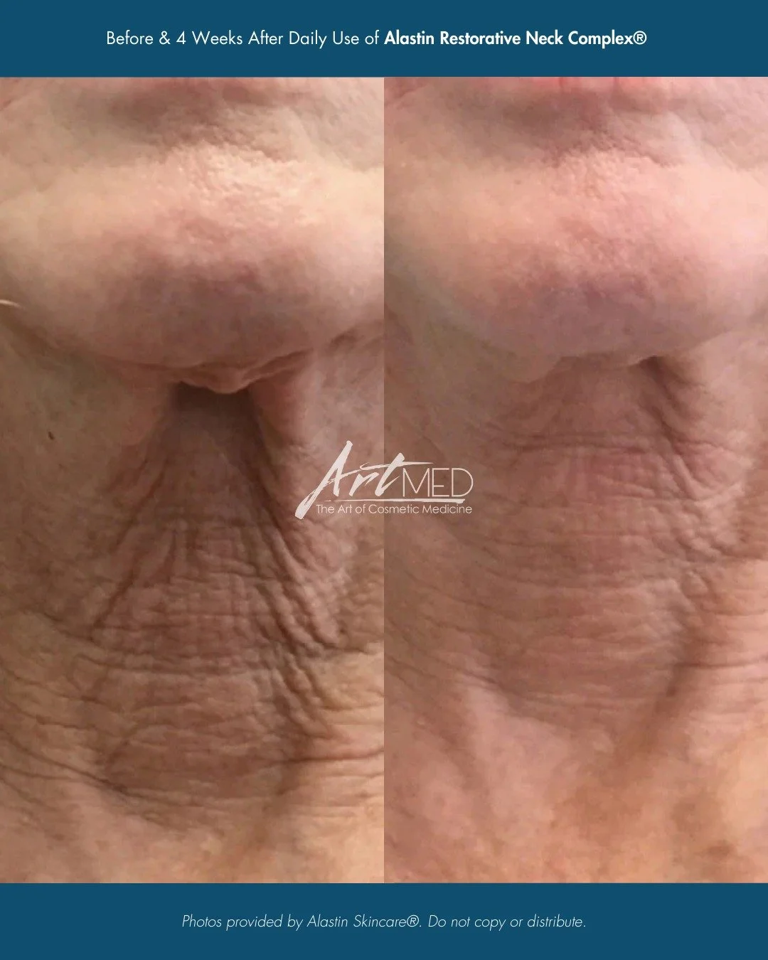 Alastin Restorative Neck Complex | 4-Week Results ✨

The neck is one of the first areas to show visible signs of aging, and it requires targeted care.

After just 4 weeks of consistent use, Alastin Restorative Neck Complex helps improve the appearanc