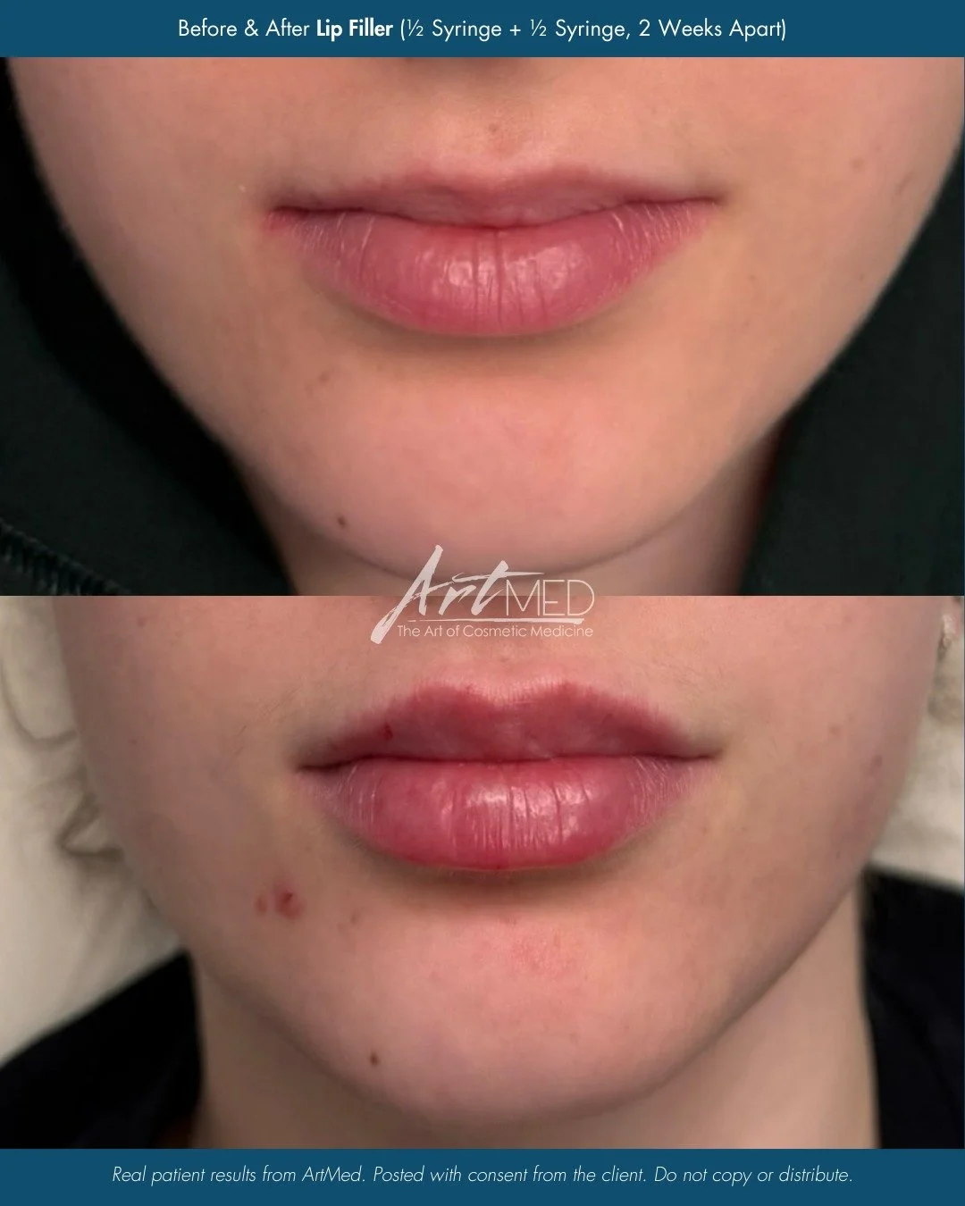 Subtle, balanced, and beautiful. ✨

This before and after shows lip filler results by Nurse Vanessa (@_injectorvanessa), using two half syringes spaced two weeks apart to gently improve symmetry and enhance shape without overfilling.

💖 15% off Mini