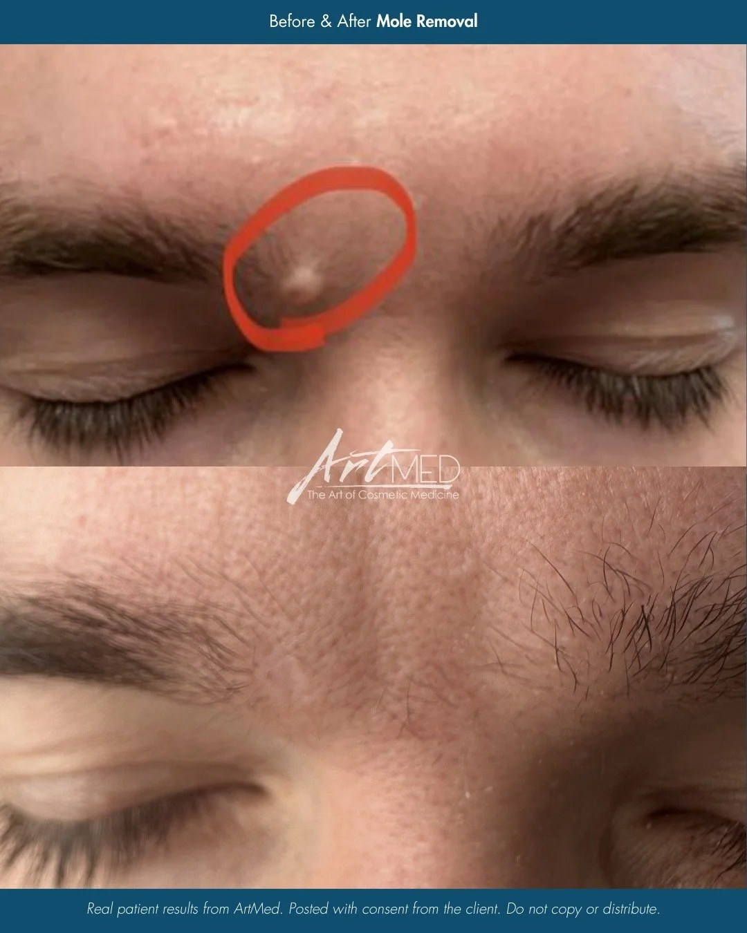 Results don&rsquo;t stop at the procedure. They continue to evolve.

This one-year comparison highlights how healing and scar maturation improve over time following excision and suturing.

✔️ Upload a photo through our link in bio
✔️ Receive a free p