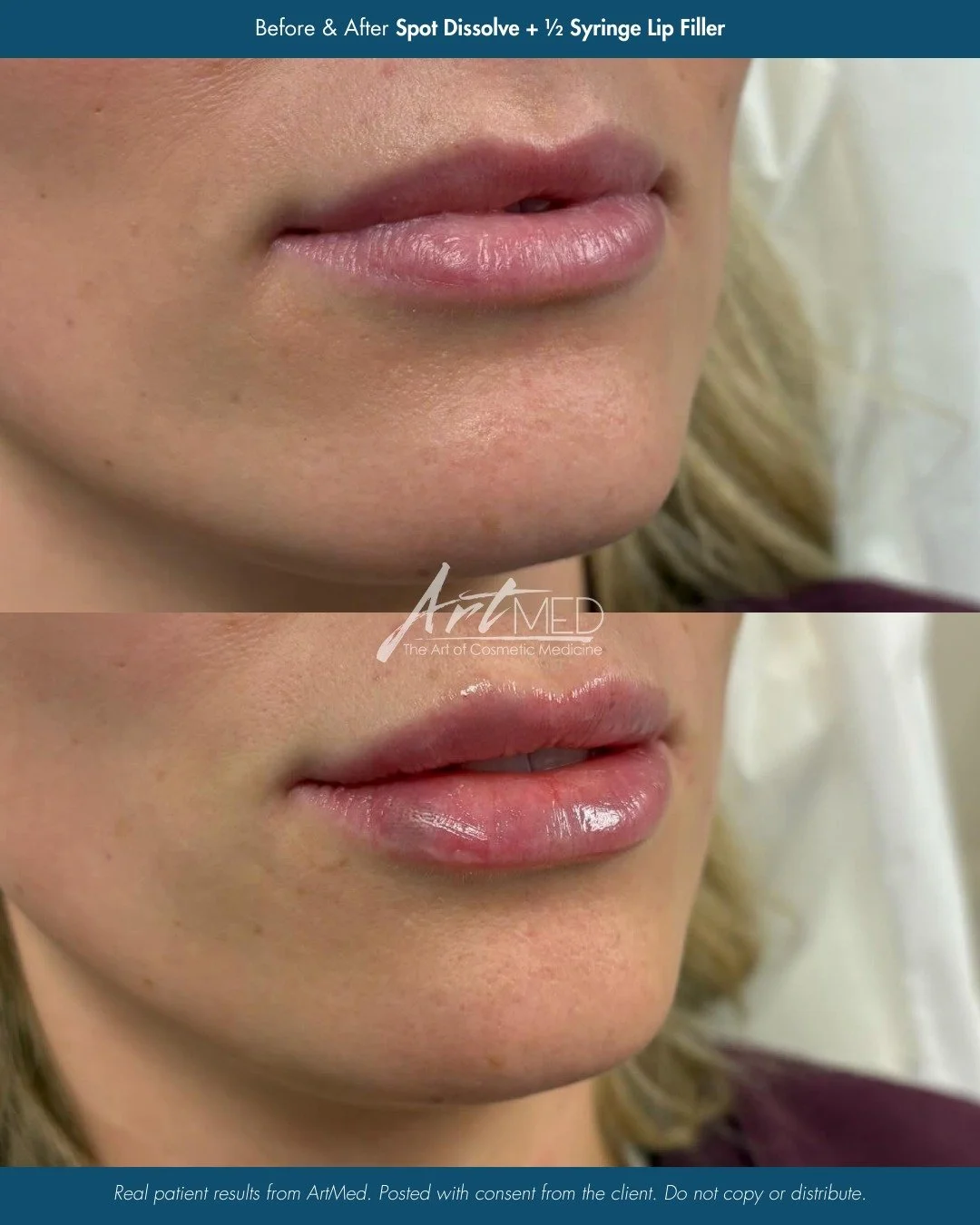 Beautiful lips begin with the right foundation.

Not every lip filler refresh is simply adding more product. In this case, Nurse Morgan (@_nursemorgan) carefully spot-dissolved previous filler to create a smoother, more balanced base before placing a