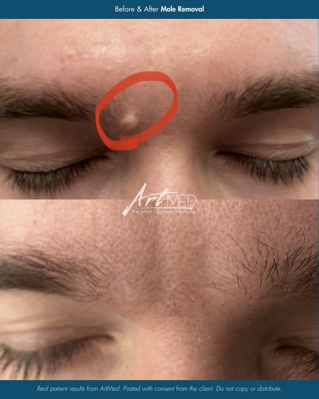 Results don&rsquo;t stop at the procedure. They continue to evolve.

This one-year comparison highlights how healing and scar maturation improve over time following excision and suturing.

✔️ Upload a photo through our link in bio
✔️ Receive a free p