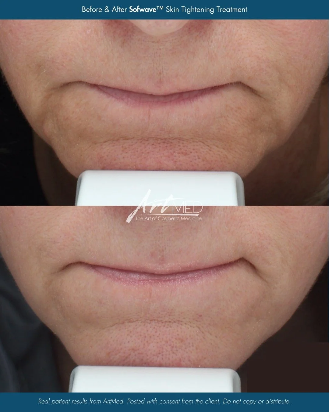 Lift, tighten, and refresh with Sofwave&trade;. ✨

Sofwave&trade; is an advanced ultrasound treatment designed to stimulate new collagen and improve skin laxity. By delivering precise energy into the mid-dermis, it helps lift and tighten areas such a