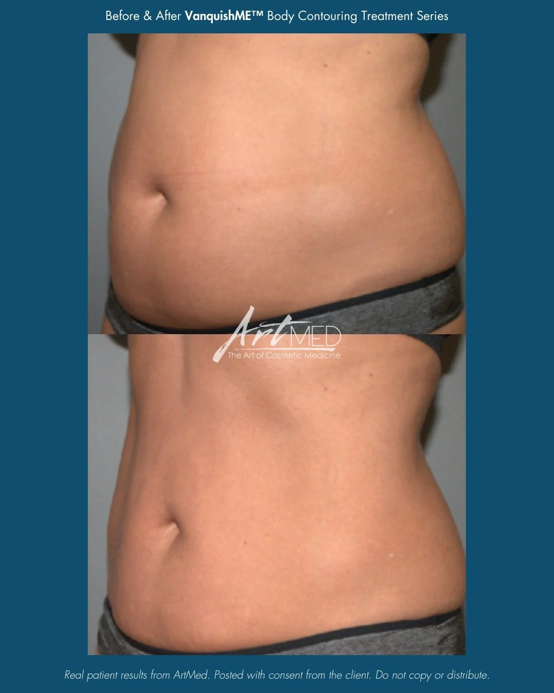 Target stubborn fat with Vanquish ME&trade;.

These before &amp; afters show real results from a series of 5 treatments, designed to gently heat and break down fat cells using radiofrequency energy. Vanquish ME&trade; treats larger areas like the abd