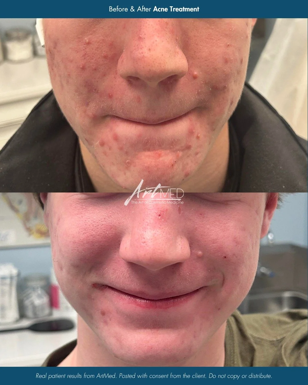 Real results from a customized acne treatment plan.

Acne is rarely treated with a one-size-fits-all approach. This transformation was achieved through a personalized plan created by our Nurse Practitioner, combining prescription-based treatments wit