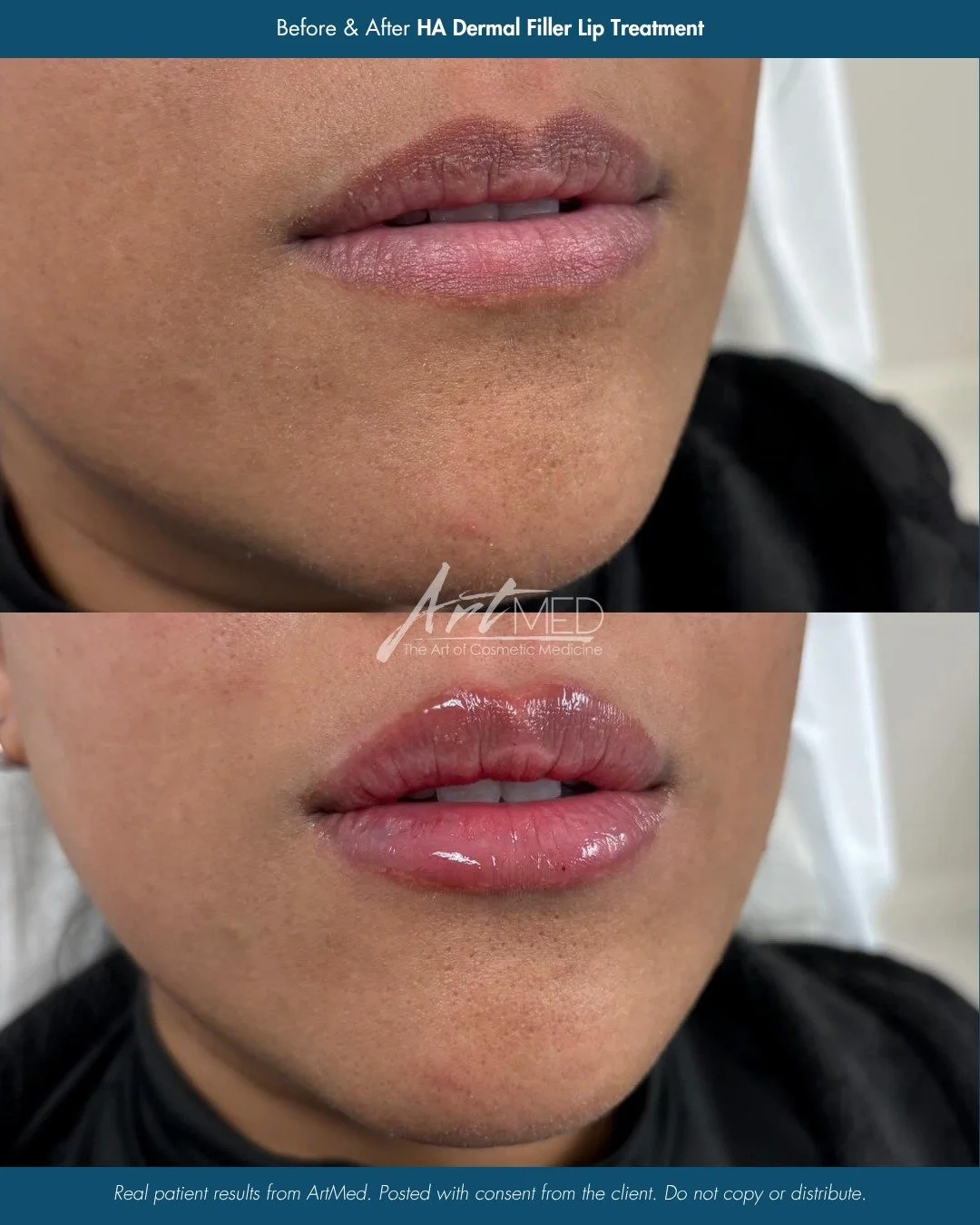 A soft, natural enhancement that lets your features shine. 💋

This result by Nurse Morgan (@_nursemorgan) focuses on restoring hydration, refining shape, and adding subtle volume for a smooth, balanced finish. Notice the improved definition and gent