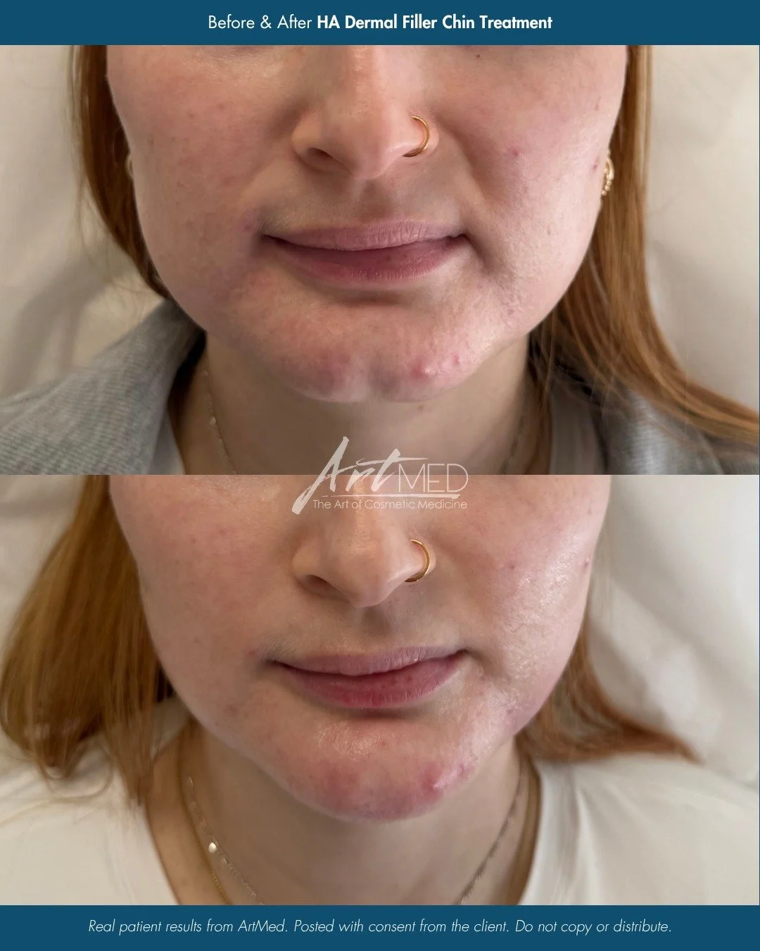 Subtle structure, balanced results. ✨

This HA dermal filler chin treatment enhances the lower face by adding gentle projection and support where it&rsquo;s needed most. By refining the chin, we can improve overall facial harmony and create a more de