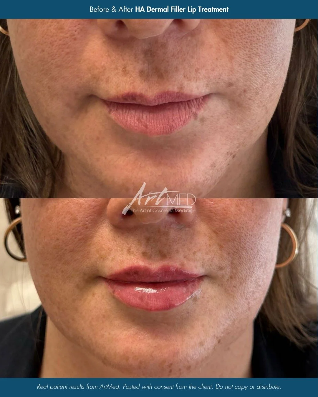Soft volume, refreshed shape. ✨

This HA dermal filler lip treatment enhances what&rsquo;s already there, adding hydration, definition, and subtle volume while maintaining the client&rsquo;s beautiful natural lip shape.

The result is smooth, balance