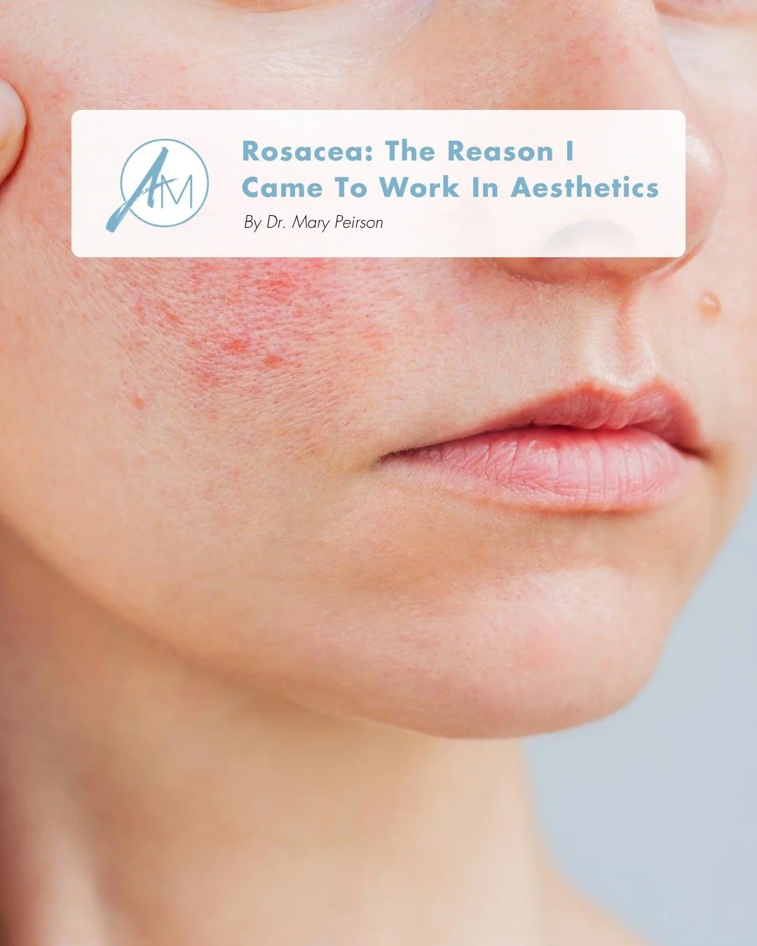 April is Rosacea Awareness Month and Dr. Mary Peirson shares a personal perspective on why this condition is so meaningful in her journey into aesthetics.

Rosacea is more than just redness, it&rsquo;s a chronic inflammatory skin condition that can i