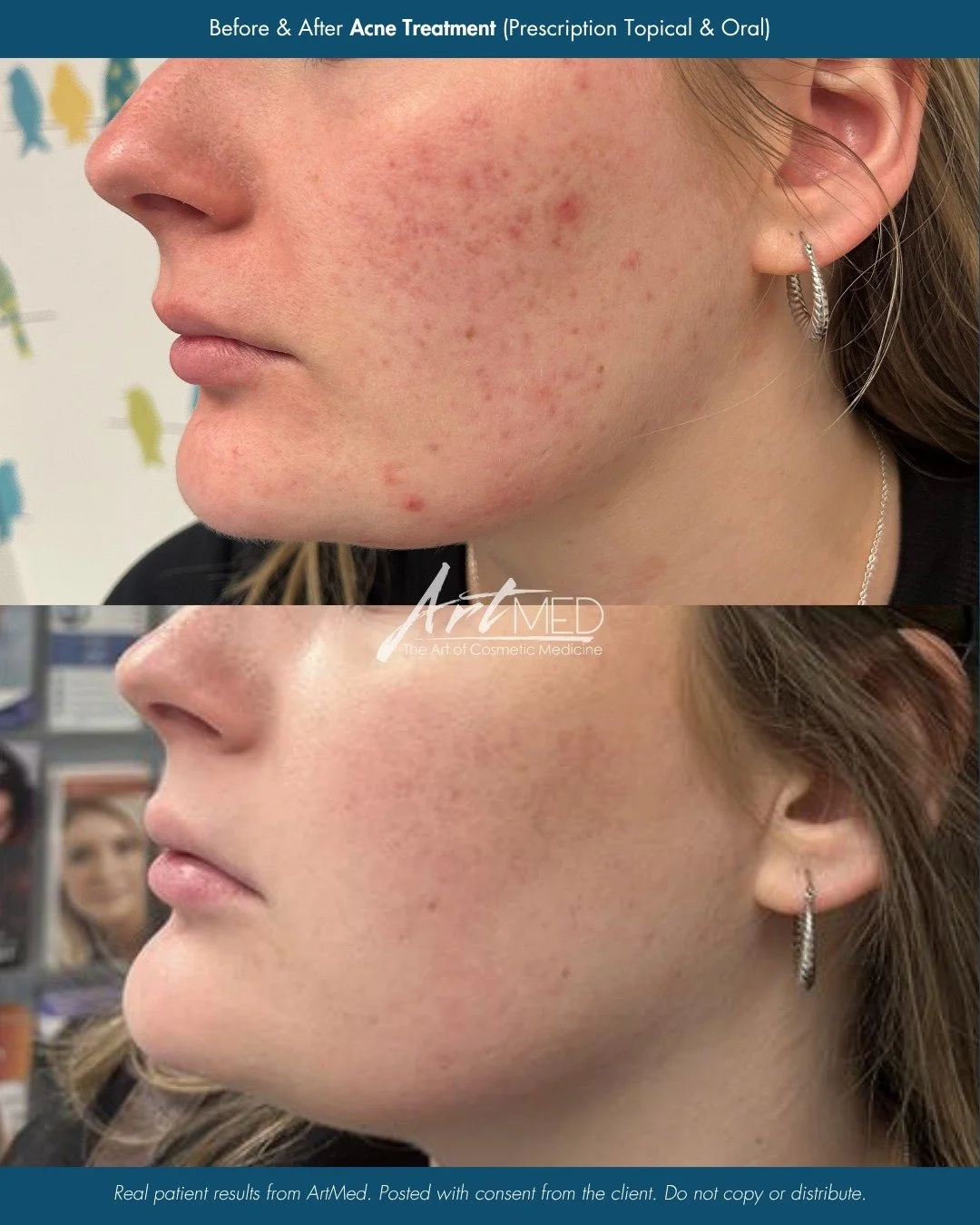 Acne is not one-size-fits-all and neither is the treatment.

This transformation was achieved with a personalized treatment plan created by our Nurse Practitioner, Ingrid, combining both topical and oral medications to target breakouts at multiple le