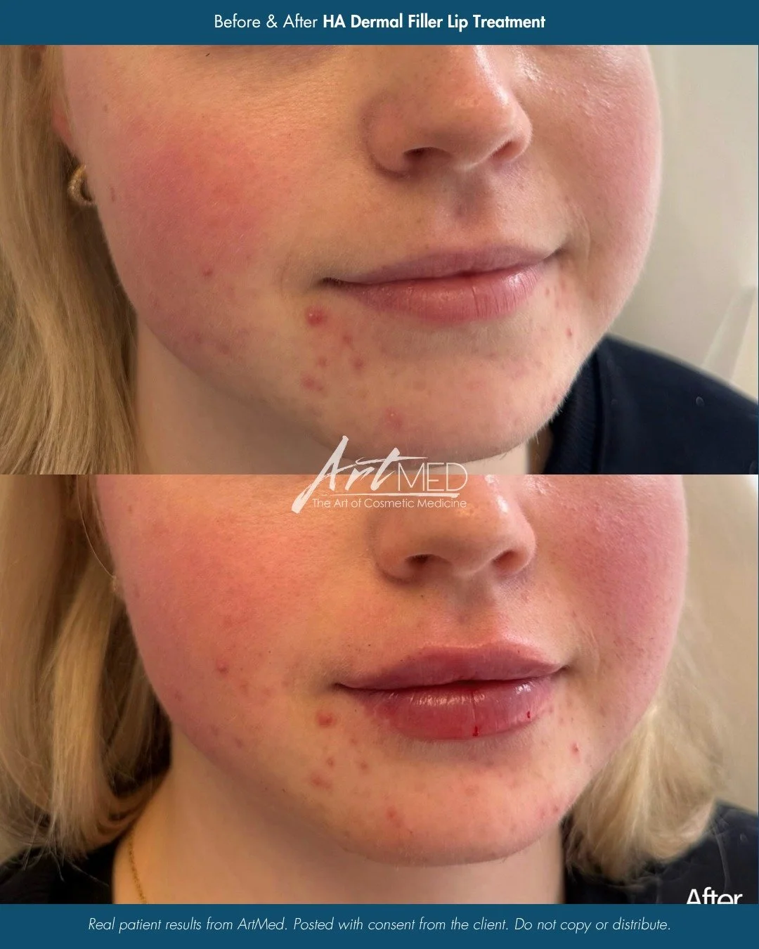 Before ➡️ After: Lips by Nurse Vanessa (@_injectorvanessa) ✨

This HA dermal filler lip treatment focuses on refining shape, improving definition, and enhancing what&rsquo;s already there - never overdone, always natural.

Balanced, hydrated, and bea