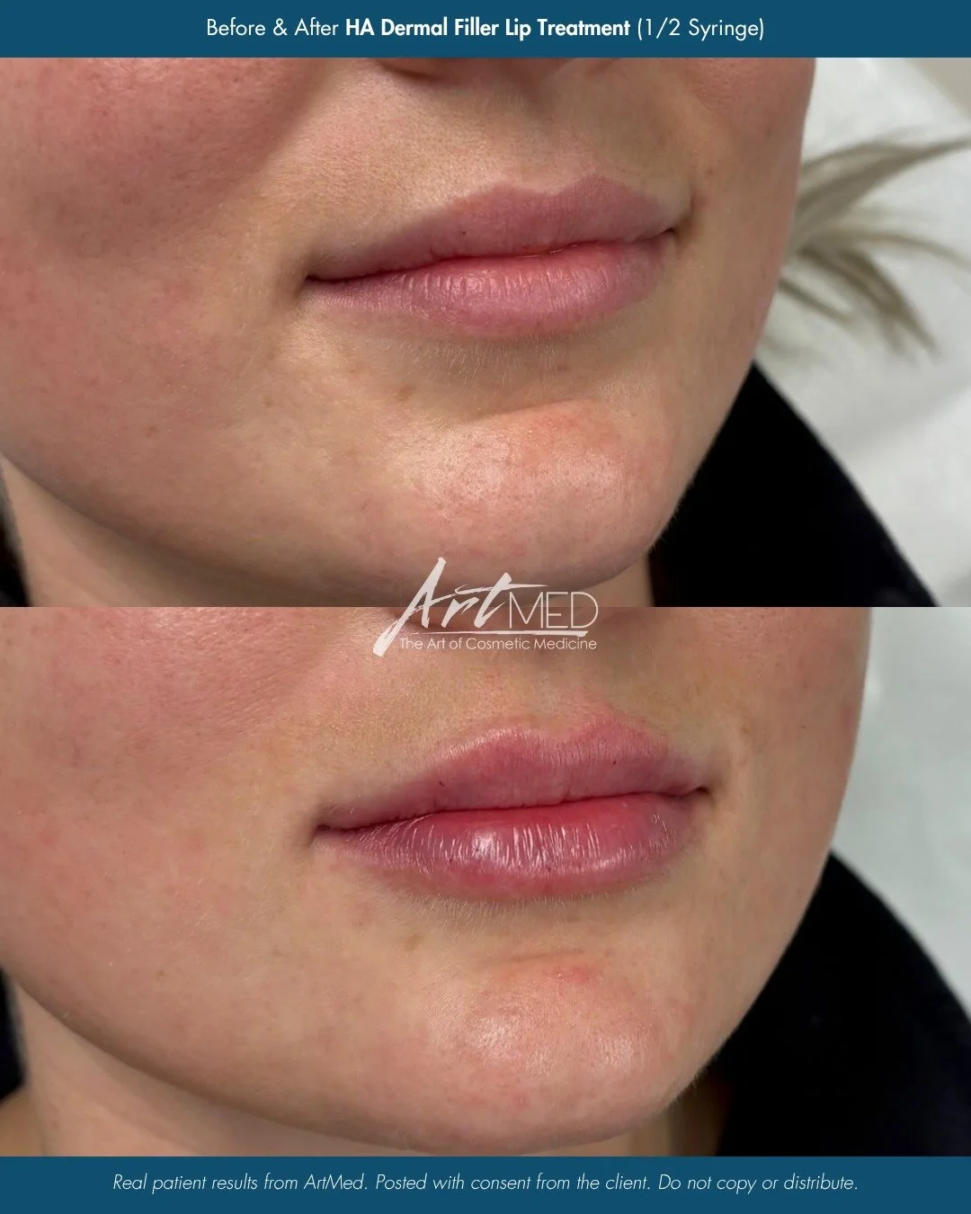 Subtle, elegant, and beautifully balanced ✨

These natural-looking lip enhancement results were achieved using just 1/2 syringe of HA dermal filler by Nurse Morgan (@_nursemorgan). A small amount of filler can make a beautiful difference by enhancing