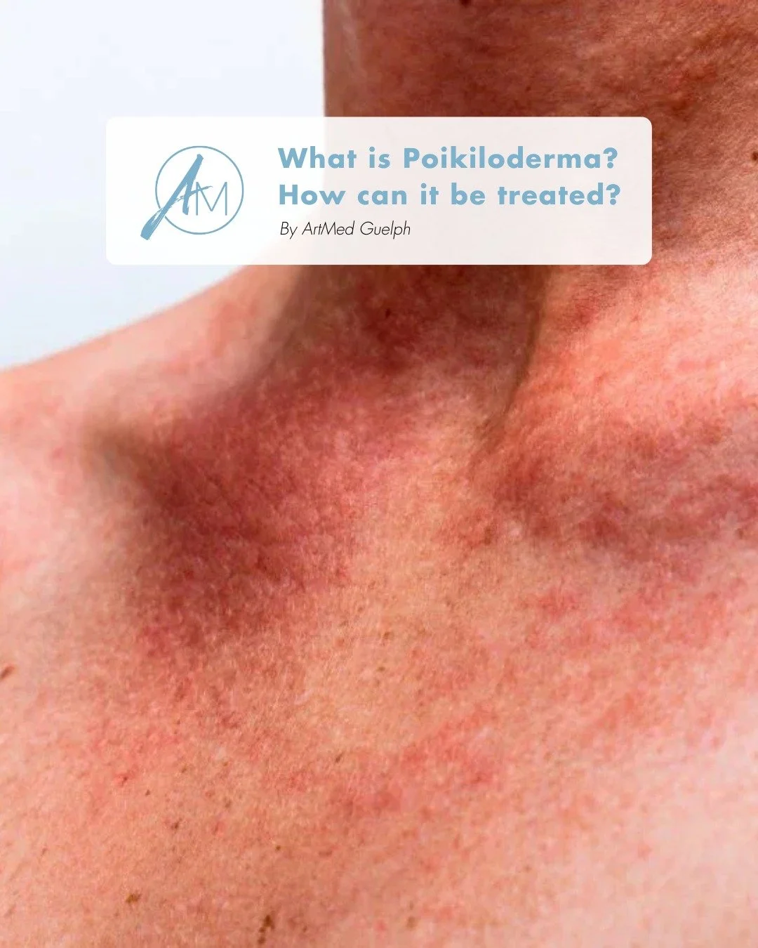 Noticing redness, pigmentation, or sun damage on the sides of the neck and chest? It may be Poikiloderma of Civatte.

This very common condition is often related to cumulative sun exposure and aging, causing:
☀️ Redness
☀️ Brown pigmentation
☀️ Visib