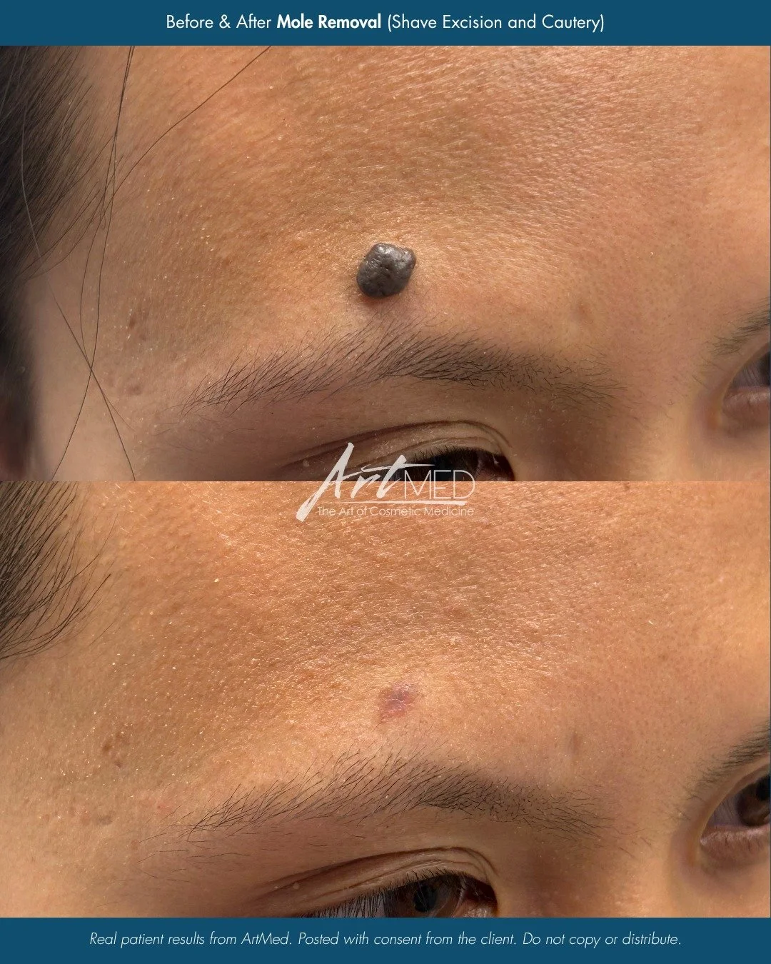 This patient underwent mole removal with our Nurse Practitioner using a shave excision and cautery technique. The raised mole was removed, leaving behind a small area of post-treatment pigmentation that will continue to fade and improve over time as 