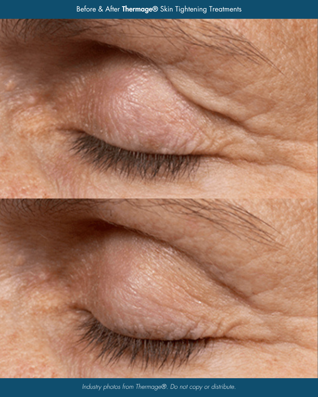 Before & After HALO Skin Tightening Treatments.png