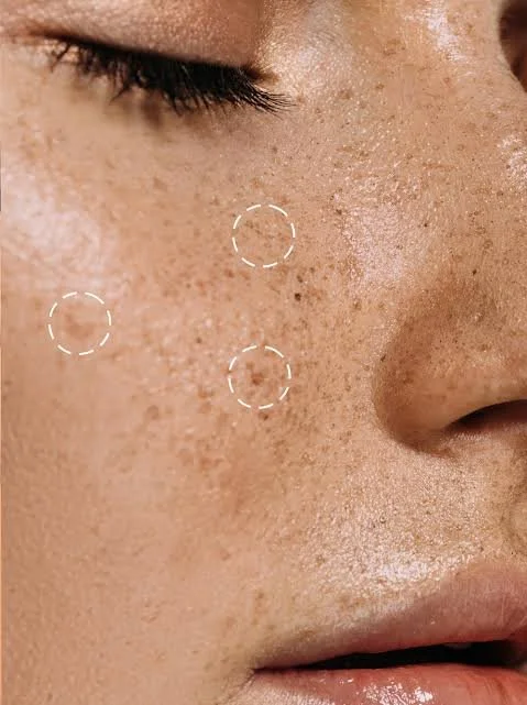 Close-up of a person's face showing acne and skin redness on the cheek and chin area.