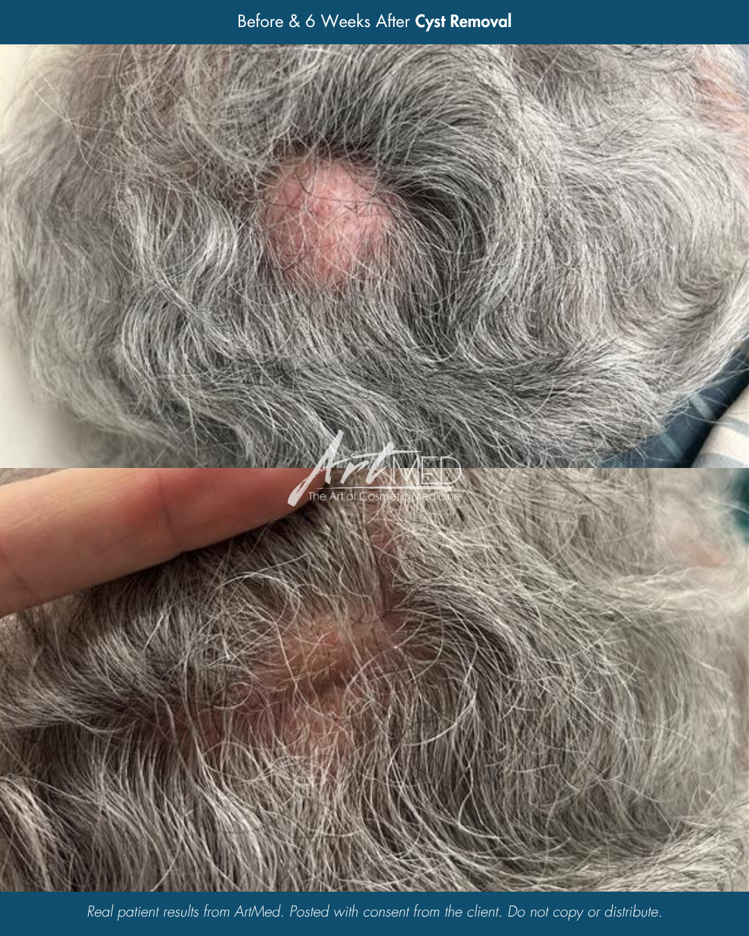 Comparison of a scalp before and six weeks after cyst removal; the top image shows a bald spot with a closed cyst, and the bottom image shows the same area with healing tissue and slightly less baldness.