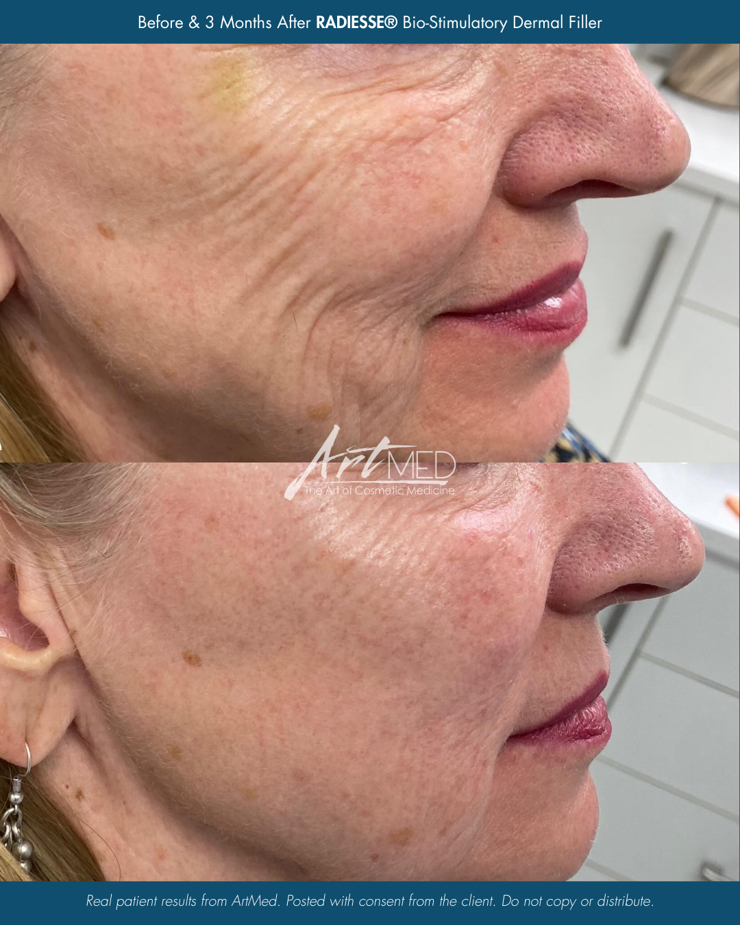 Before & After HALO Skin Tightening Treatments.png