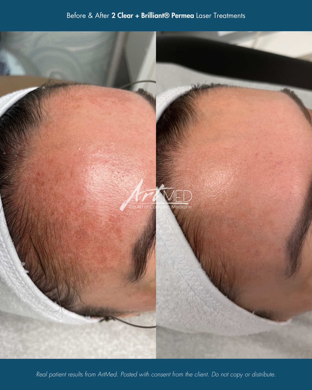 Before & After HALO Skin Tightening Treatments.png