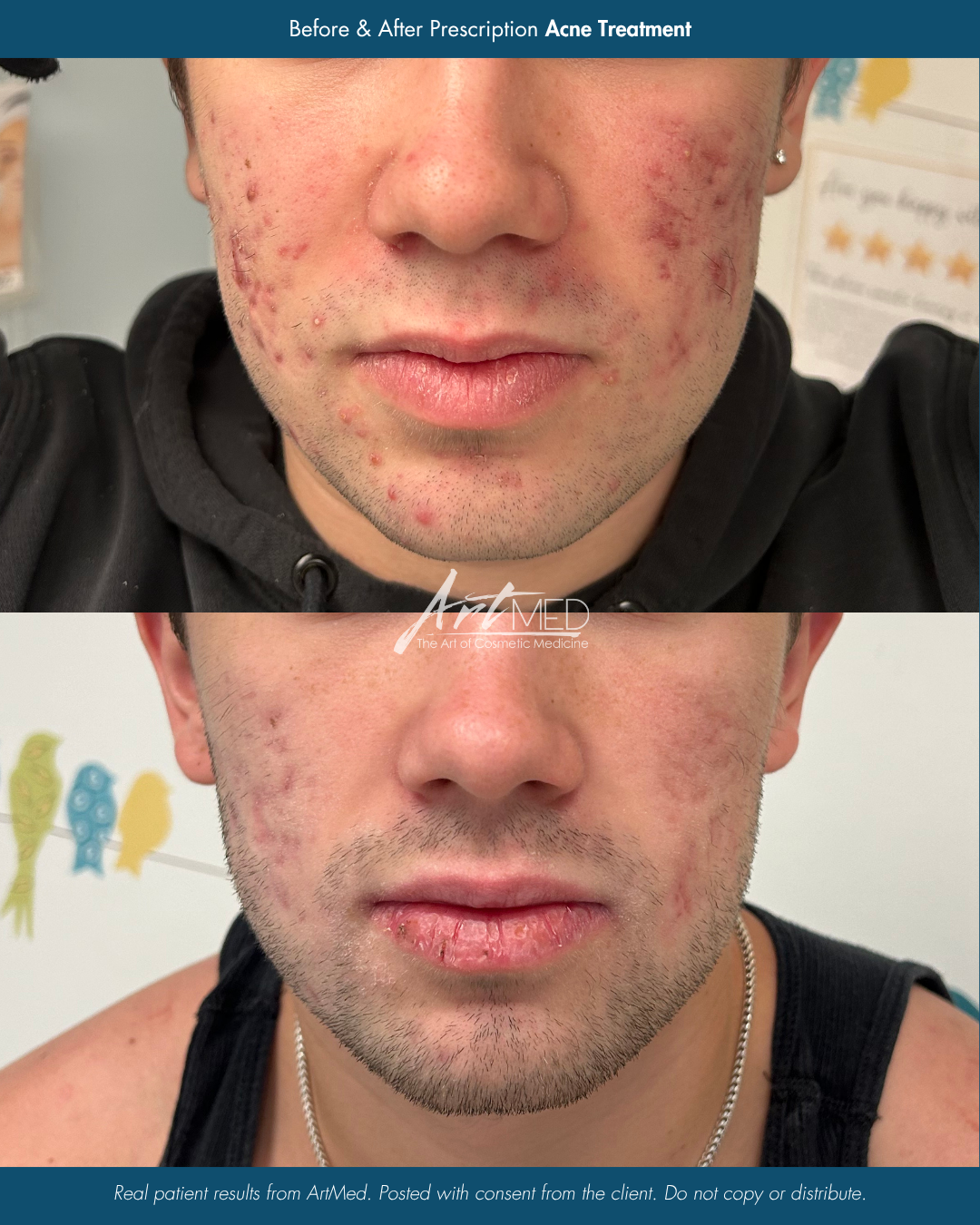 Before & After Acne Treatment.png