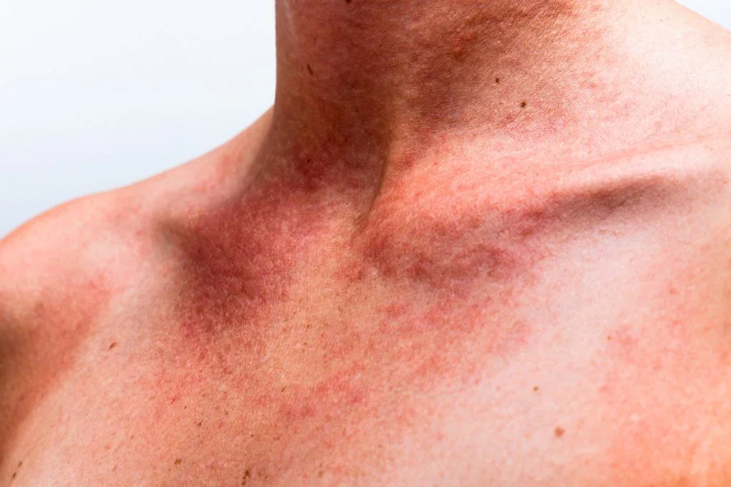 What is Poikiloderma? How can it be treated?