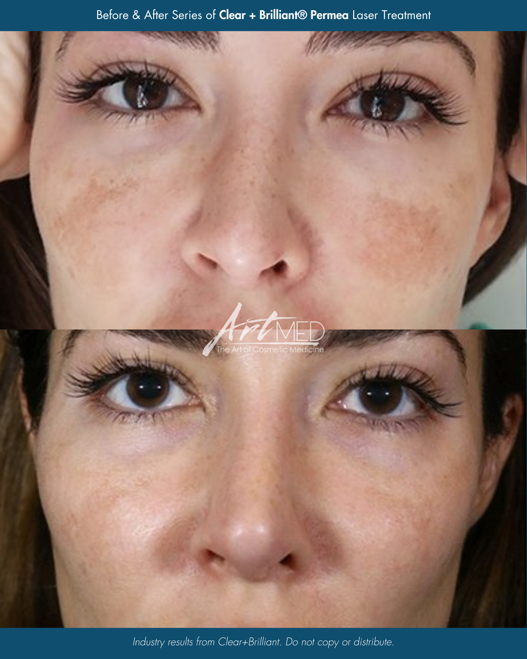 Before & After 2 x Sofwave™ Skin Tightening Treatments.png