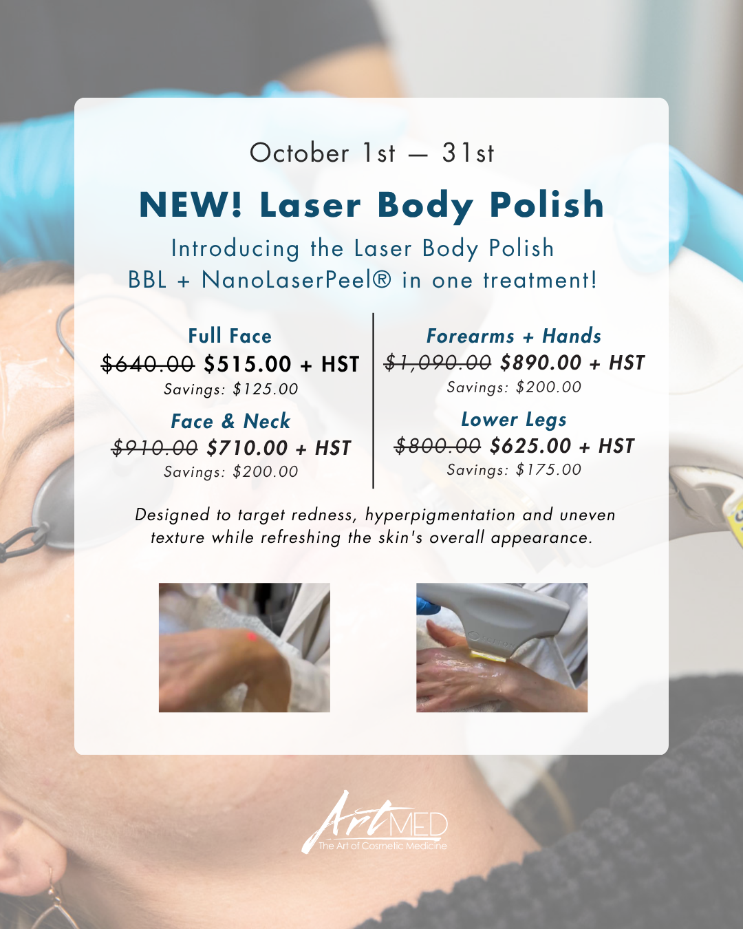 NEW! Laser Body Polish