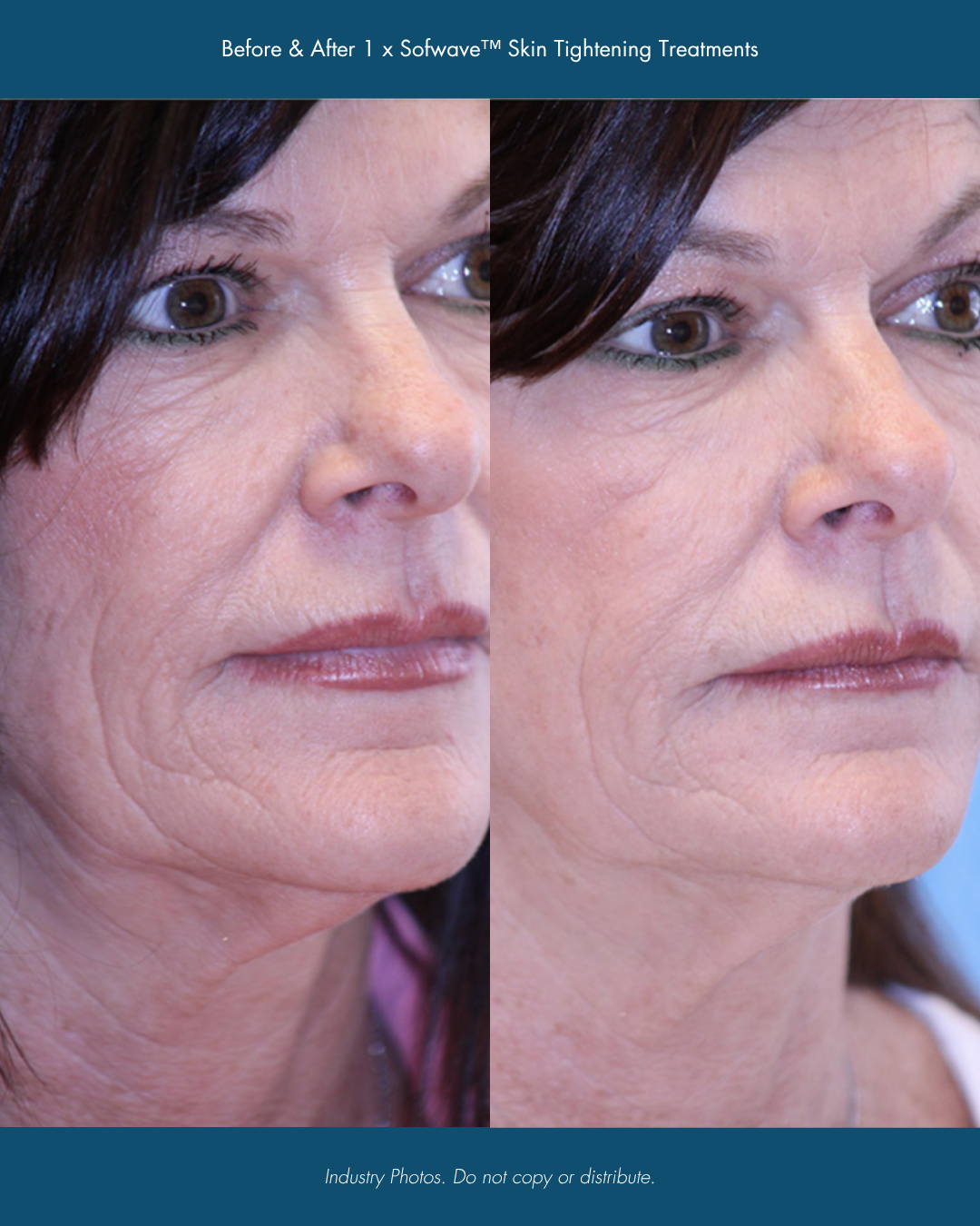 Before & After 1 x Sofwave™ Skin Tightening Treatments.png