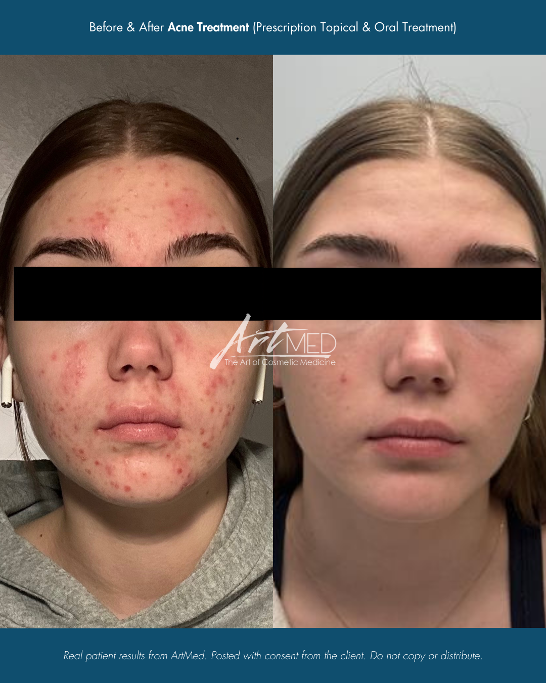 Before & After Acne Treatment (Topical & Prescription).png