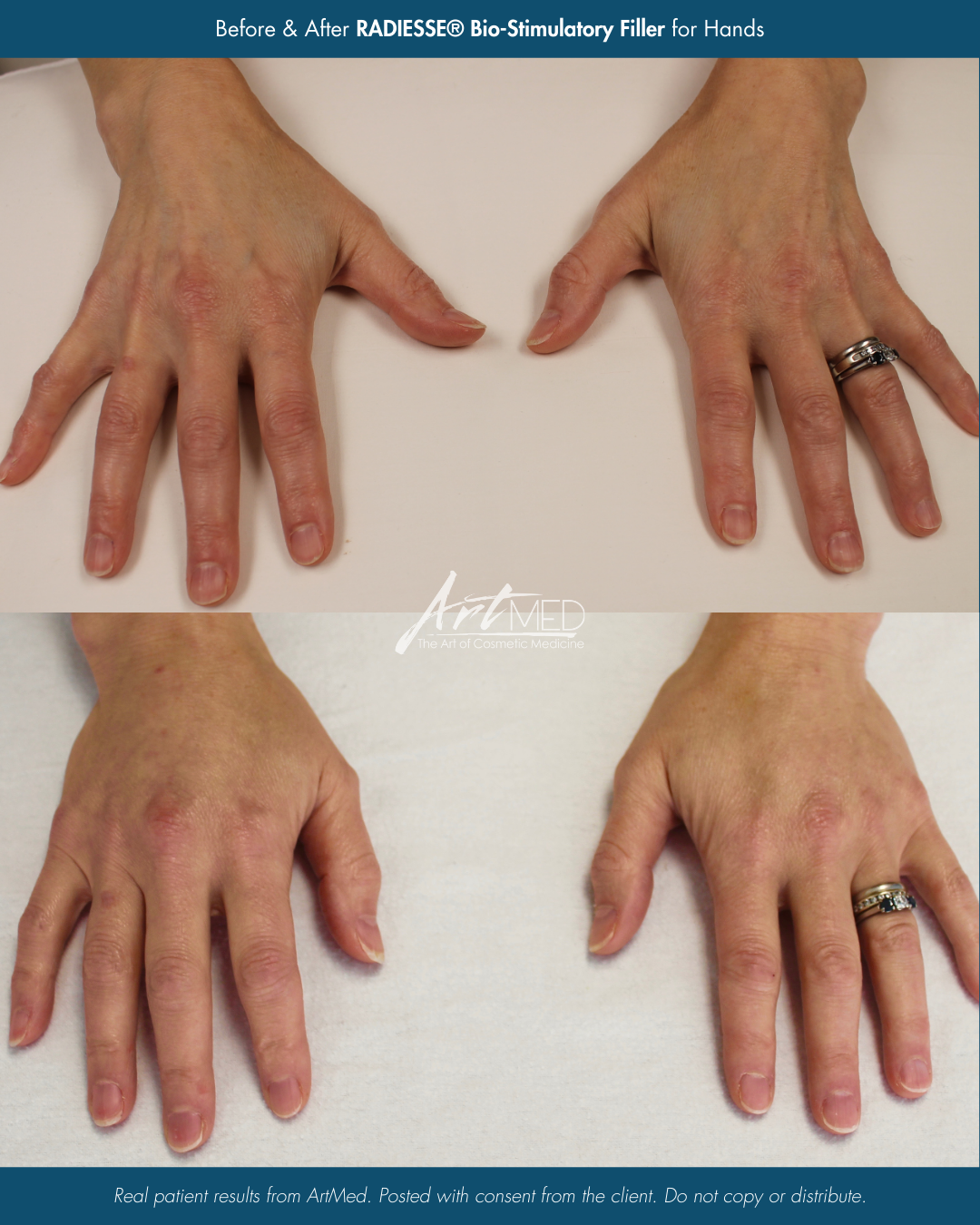 Before & After Acne Treatment (Topical & Prescription).png
