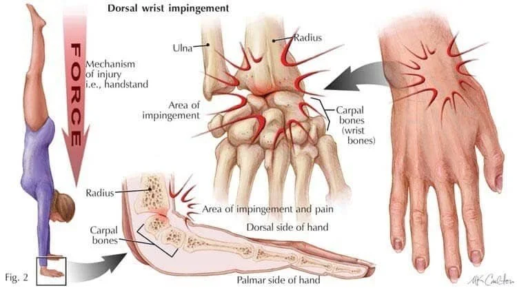 Dorsal wrist impingement, showing where the back of the radius compresses the carpal bones during wrist extension