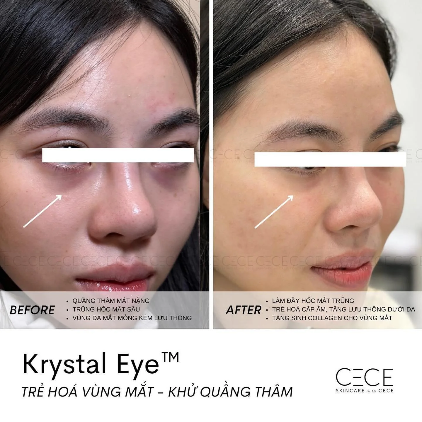 𝐊𝐑𝐘𝐒𝐓𝐀𝐋 𝐄𝐘𝐄&trade; | Khử quầng th&acirc;m mắt an to&agrave;n với c&ocirc;ng nghệ độc quyền tại CECE 

D&ugrave; kh&ocirc;ng hề quảng c&aacute;o, nhưng 𝐊𝐫𝐲𝐬𝐭𝐚𝐥 𝐄𝐲𝐞&trade; l&agrave; trị liệu được kh&aacute;ch h&agrave;ng ưa chuộng n