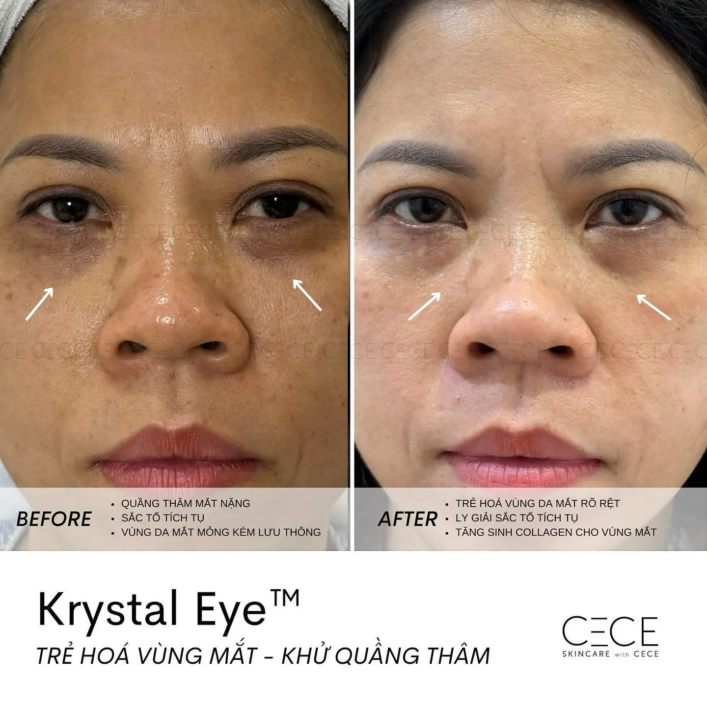 𝐊𝐑𝐘𝐒𝐓𝐀𝐋 𝐄𝐘𝐄&trade; | Khử quầng th&acirc;m mắt an to&agrave;n với c&ocirc;ng nghệ độc quyền tại CECE 

D&ugrave; kh&ocirc;ng hề quảng c&aacute;o, nhưng 𝐊𝐫𝐲𝐬𝐭𝐚𝐥 𝐄𝐲𝐞&trade; l&agrave; trị liệu được kh&aacute;ch h&agrave;ng ưa chuộng n