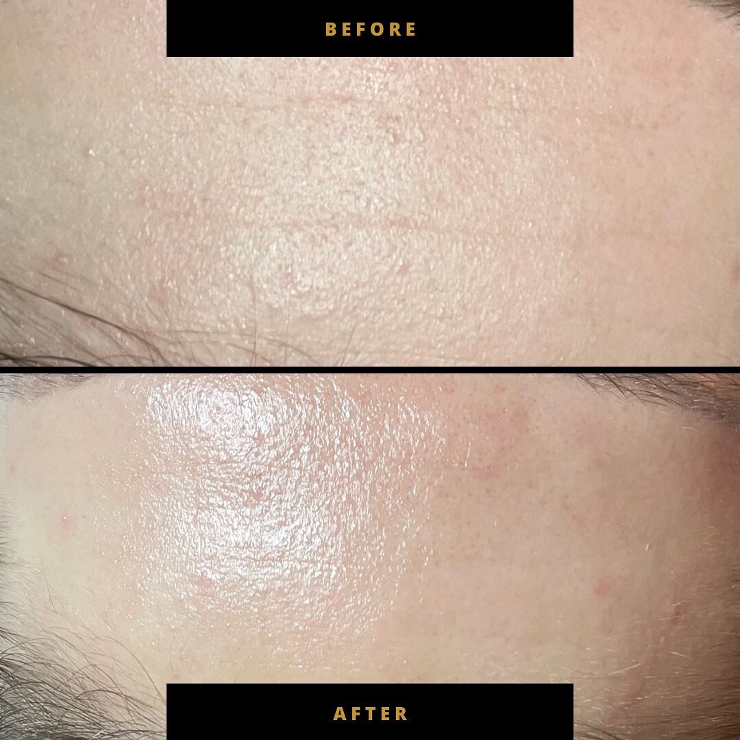 Not all forehead lines are wrinkles that will take months of treatments to improve. In fact, a lot of fine lines are dehydration lines and can easily be taken care of!

This before/after is from one treatment of The Facial + Dermaplane add-on focusin