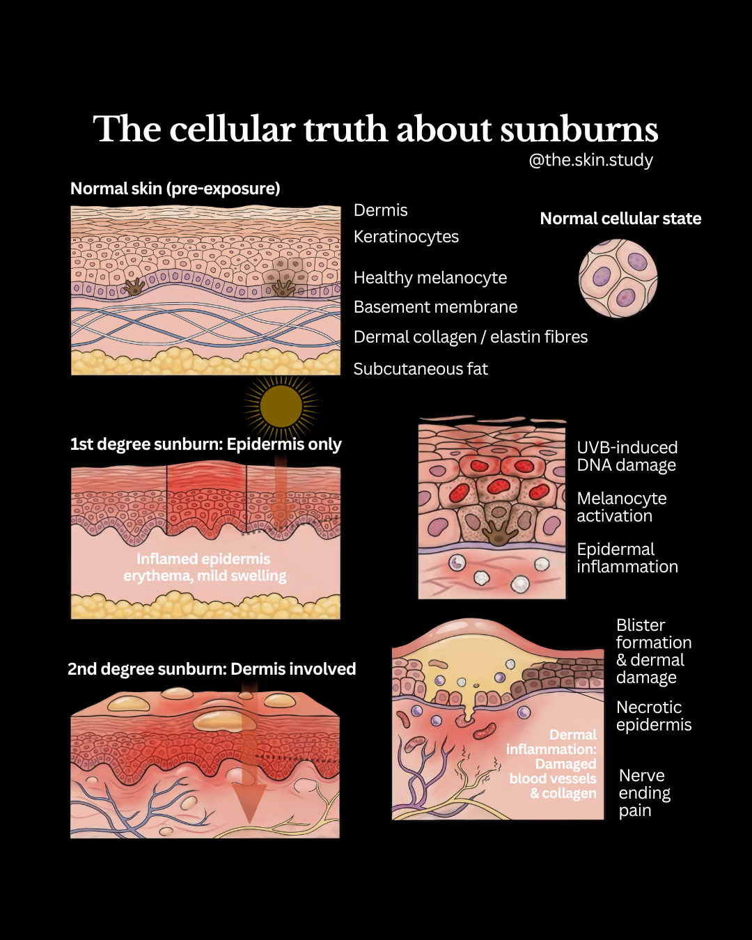 What a sunburn looks like beneath the surface | SPF care in Huntington, WV