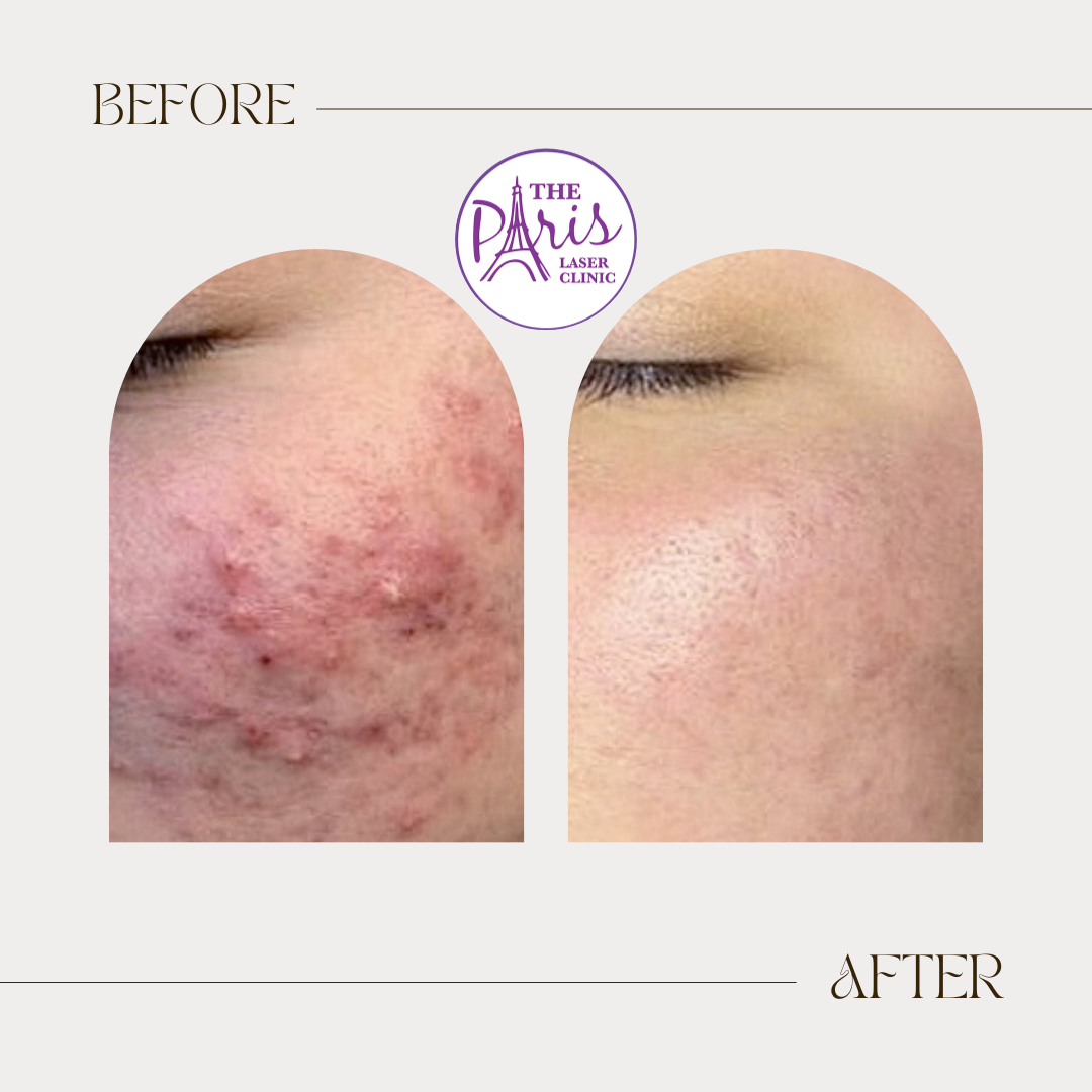 Comparison of a person's skin before and after treatment for acne scars, with the left side showing inflamed skin with scars and the right side showing smooth, clear skin.
