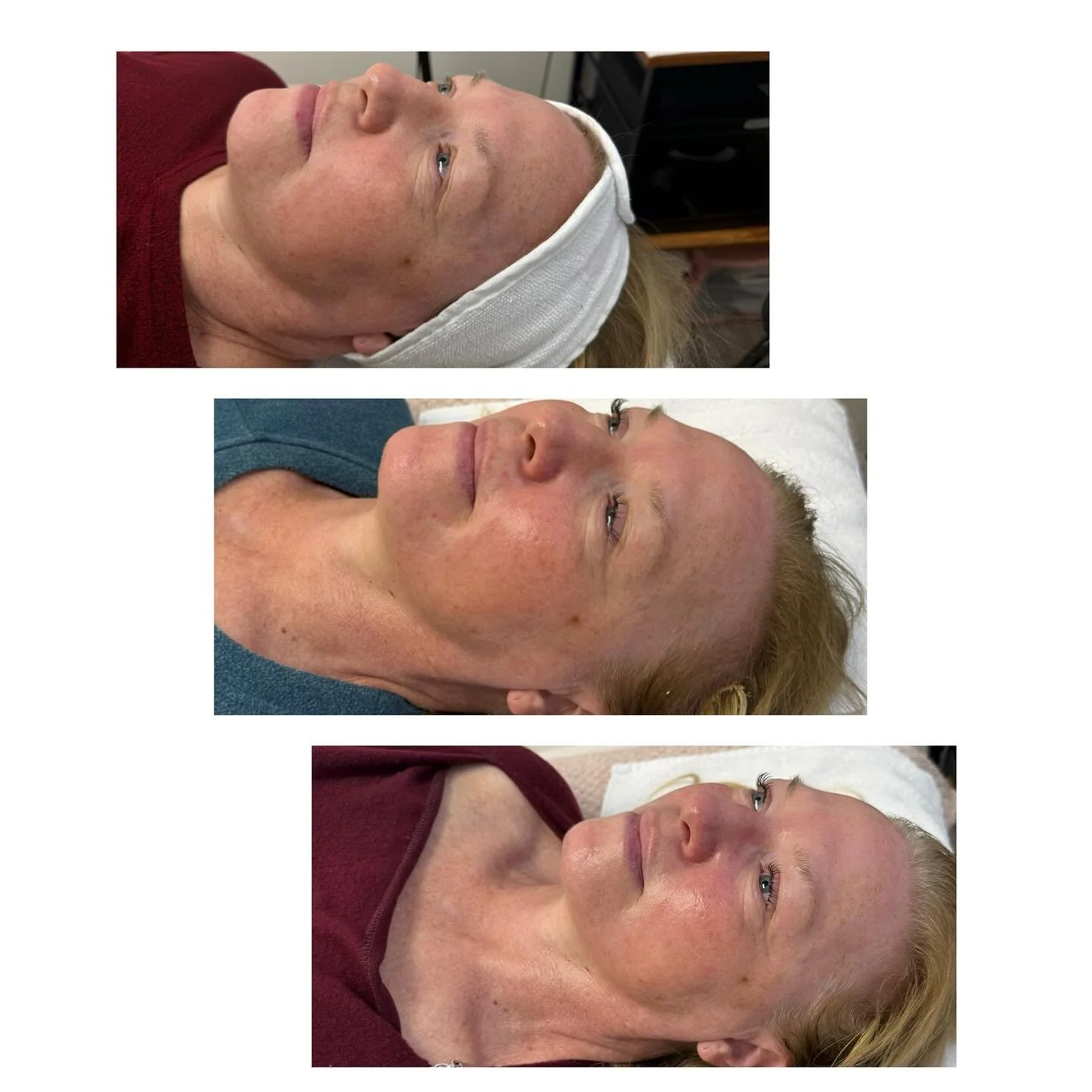 Three Jet Plasma sessions in, and the transformation is undeniable 🌟 This non-invasive treatment works on a cellular level to brighten, lift, and rejuvenate your skin — revealing a youthful, healthy glow. With no pain and no downtime. 
#JetPla