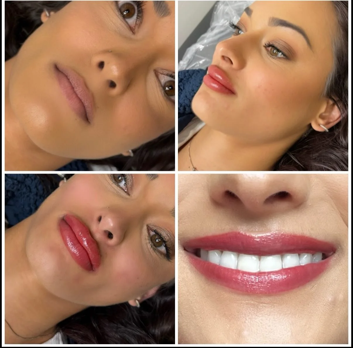 Trust the process ✨💋 Before ➜ After ➜ 24 hours later&hellip; healed beauty already peeking through. So obsessed.