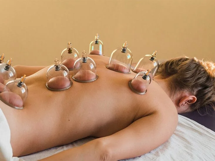 Person receiving cupping therapy on back with multiple glass cups applied.