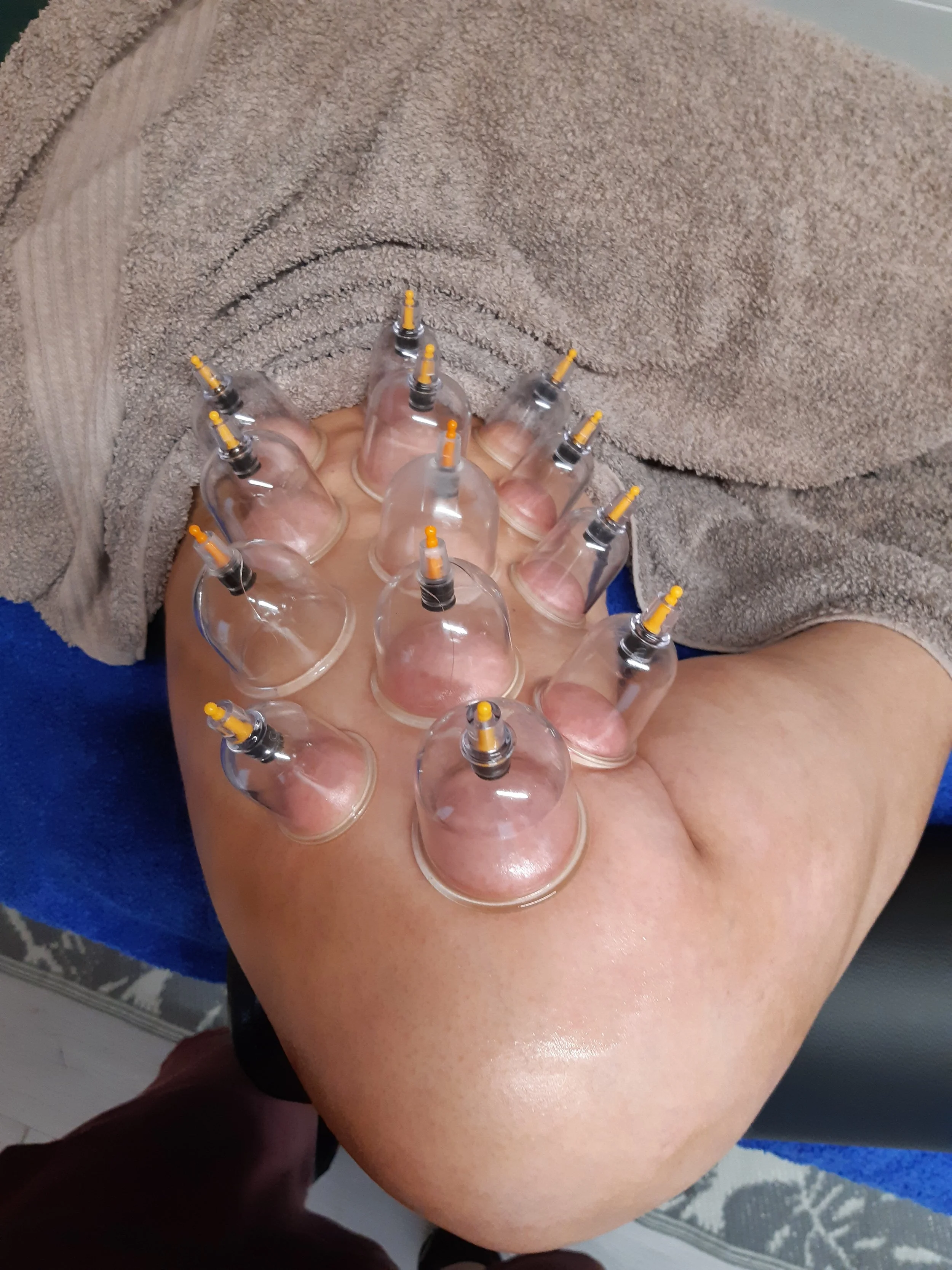 Plastic cups used in cupping therapy on a person's back, covered with a towel.