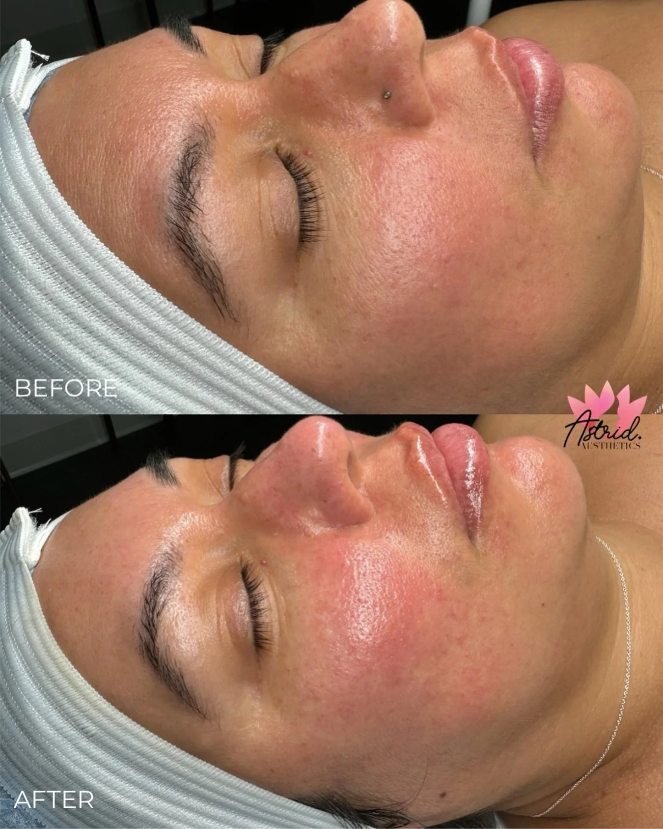 Refresh your skin with a Deep Pore Cleansing Facial and Hydrating Treatment&mdash;unclog pores, restore hydration, and reveal a radiant glow!

Click link in bio to book or send a DM 🫶🏼

📲 www.astrid-aesthetics.com
📞 (714) 493-4294
📍 Costa Mesa, 