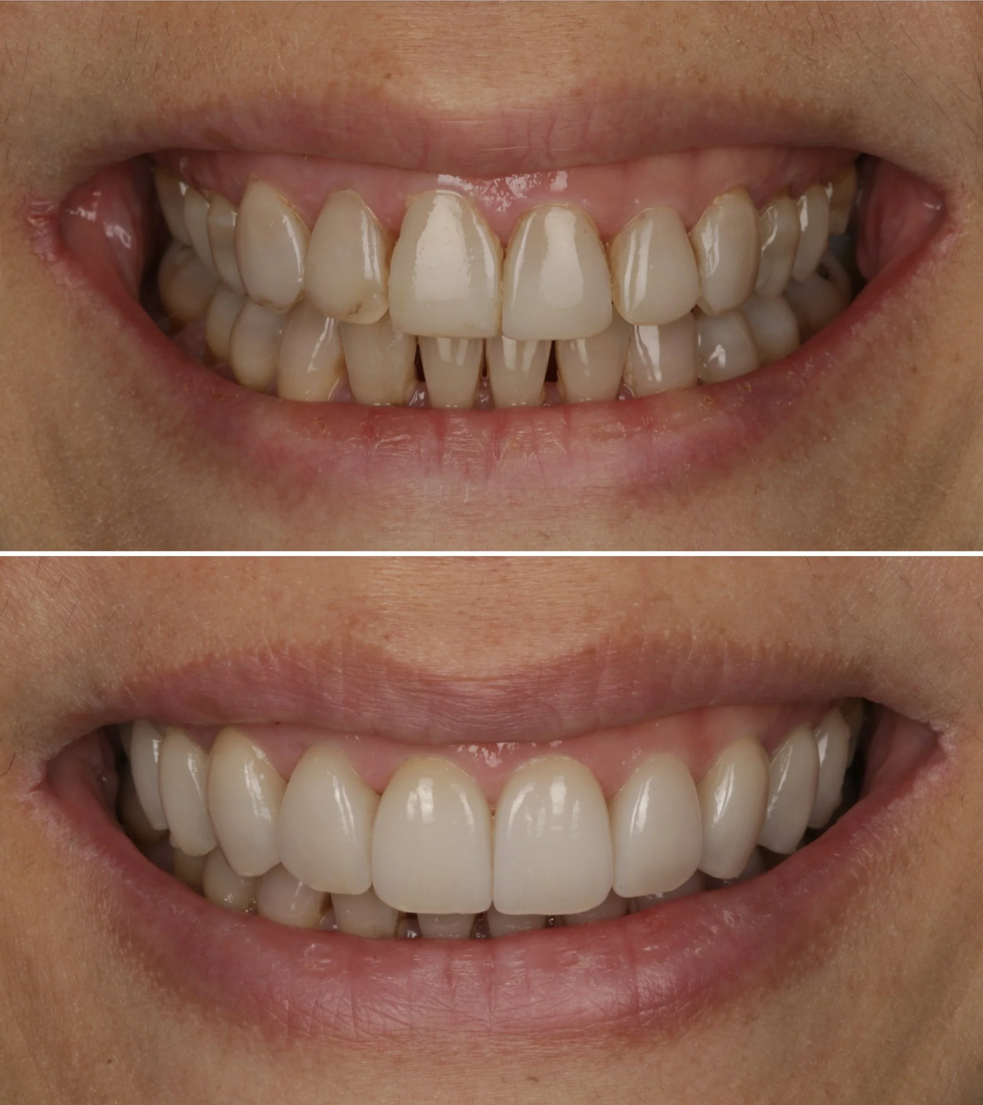 Replacement of 6 old composite veneers with porcelain veneers and addition of 4 porcelain veneers
