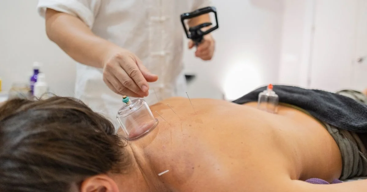 What Is Cupping Treatment and How Does It Work?
