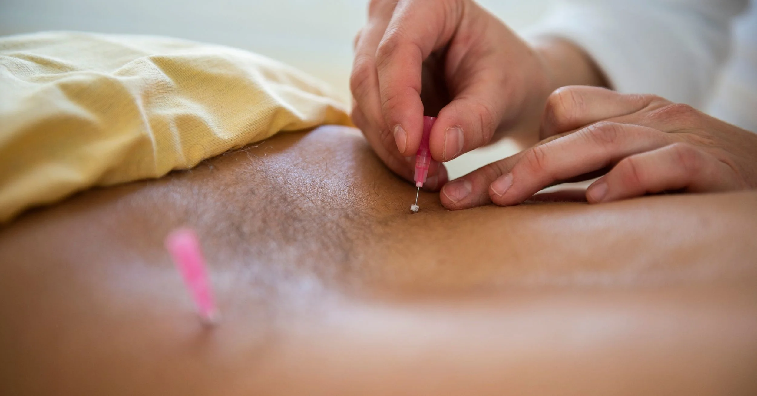 Acupuncture for a Pinched Nerve: Natural Pain Relief