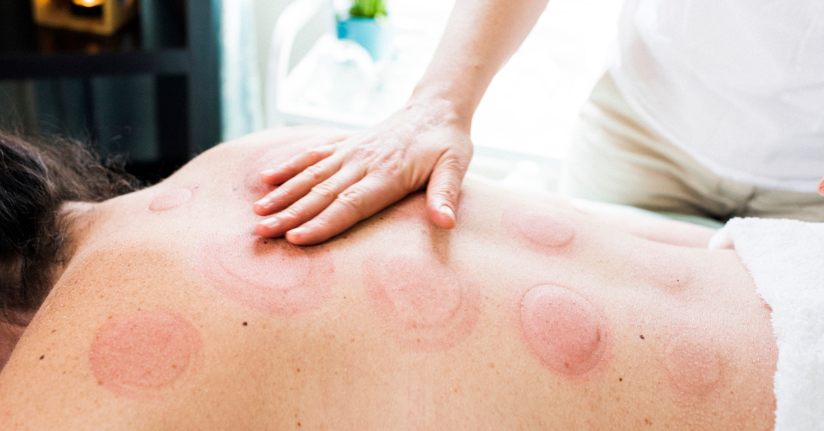 A person's back showing circular red marks after a cupping therapy session, with a therapist's hand resting on the skin.