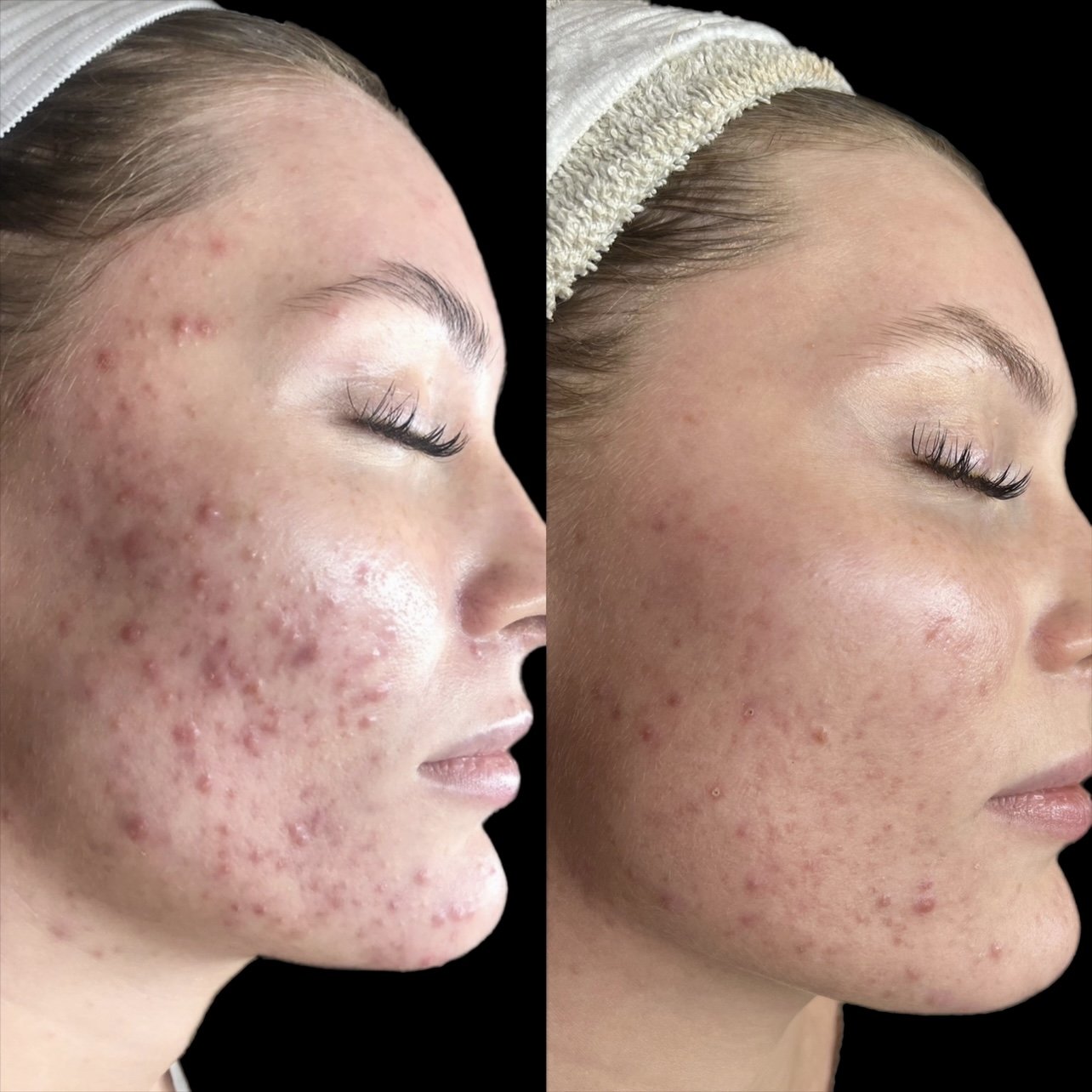 acne-clearing-results-knoxville.jpg