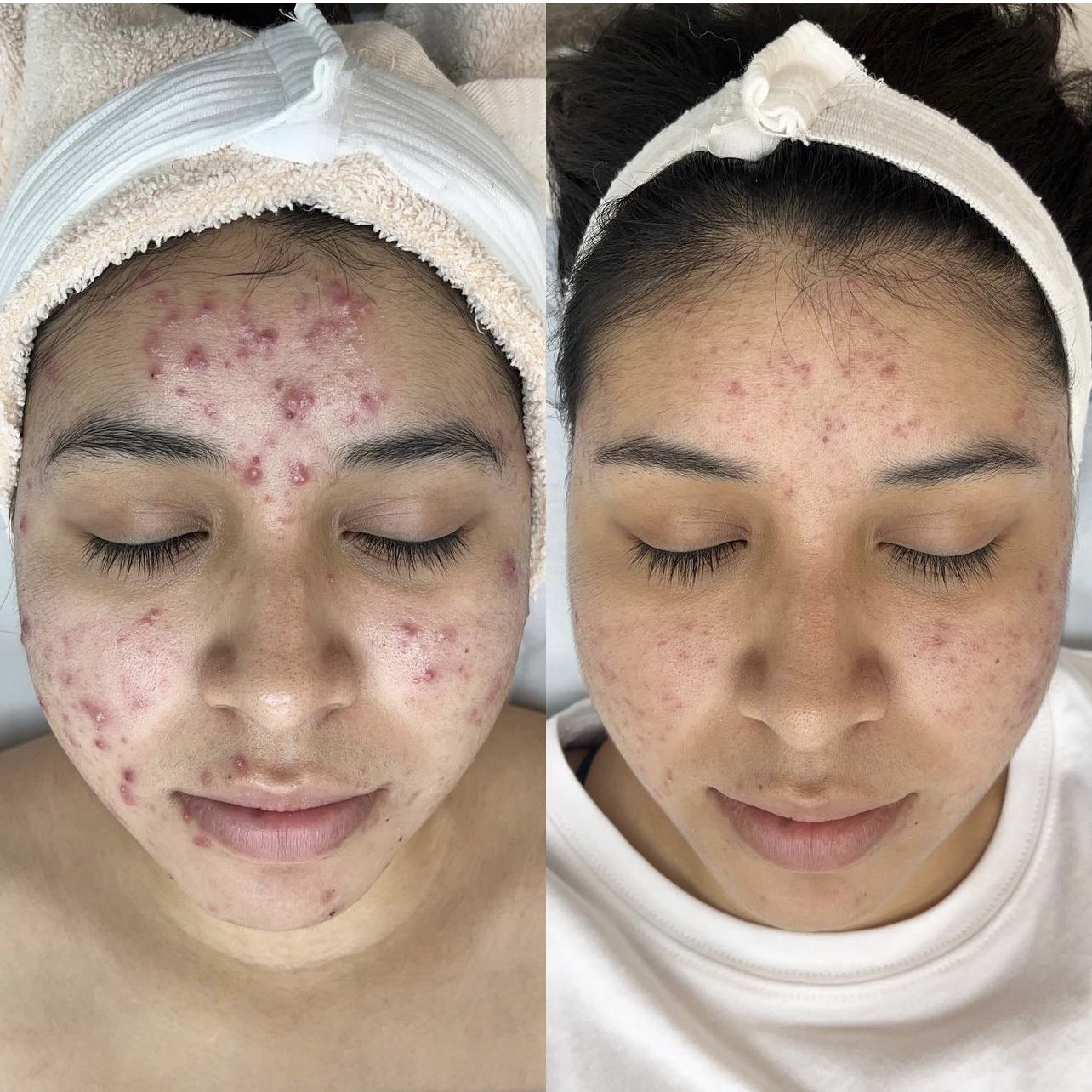 acne-treatments-knoxville.jpg