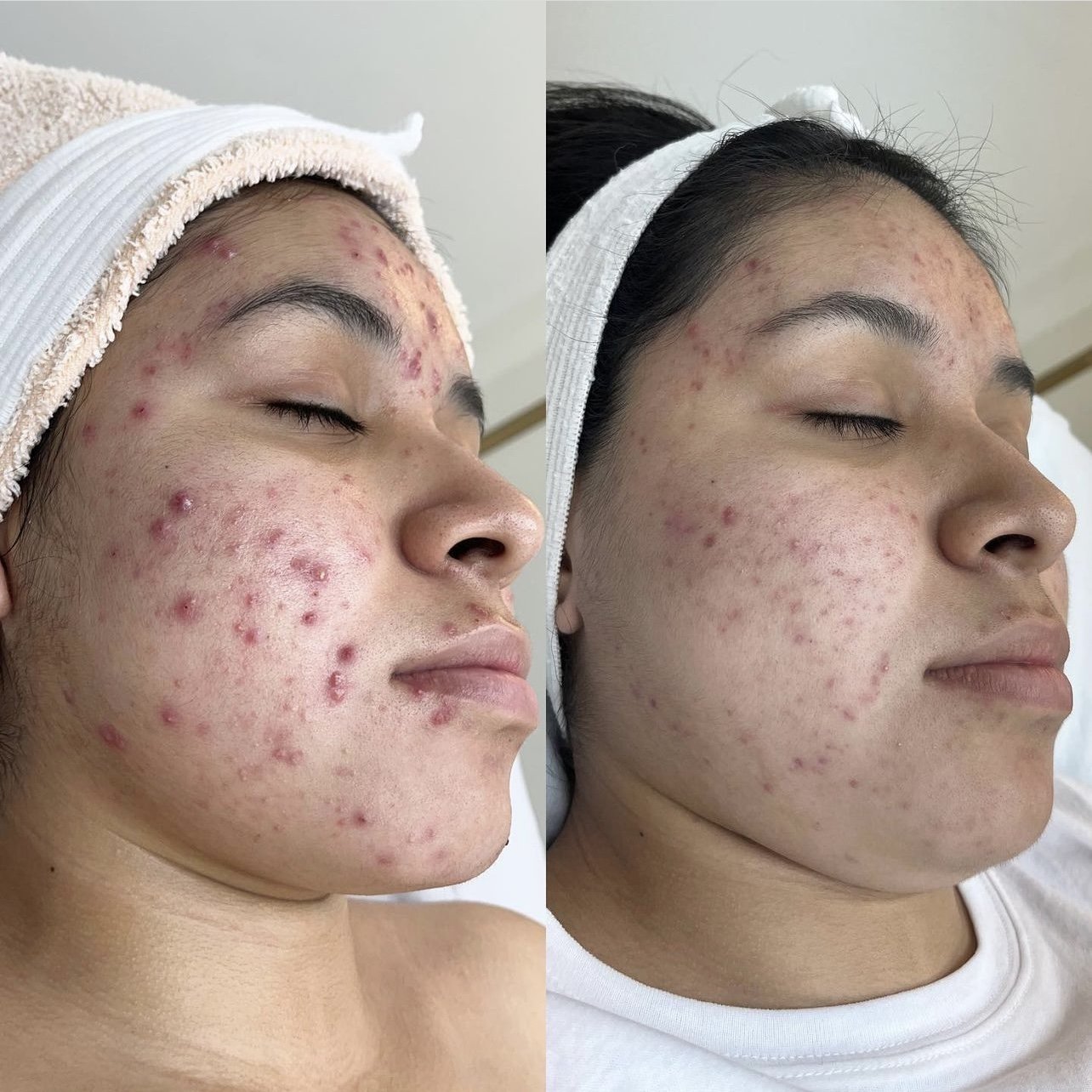 acne-treatments-knoxville-tn.jpg