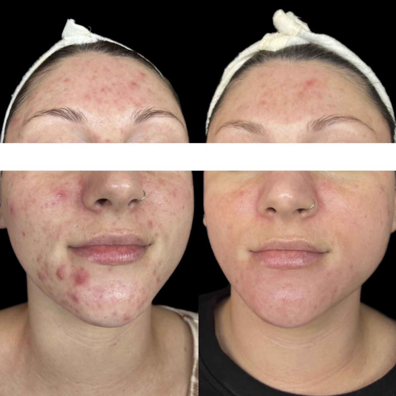 acne-treatment-near-me-knoxville-.jpg