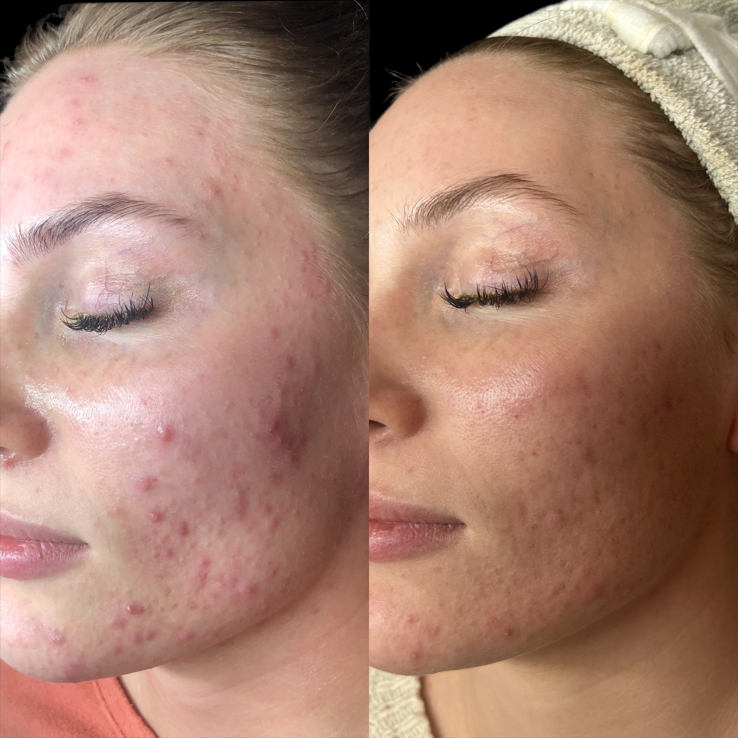 acne-treatment-skincare-knoxville.JPG