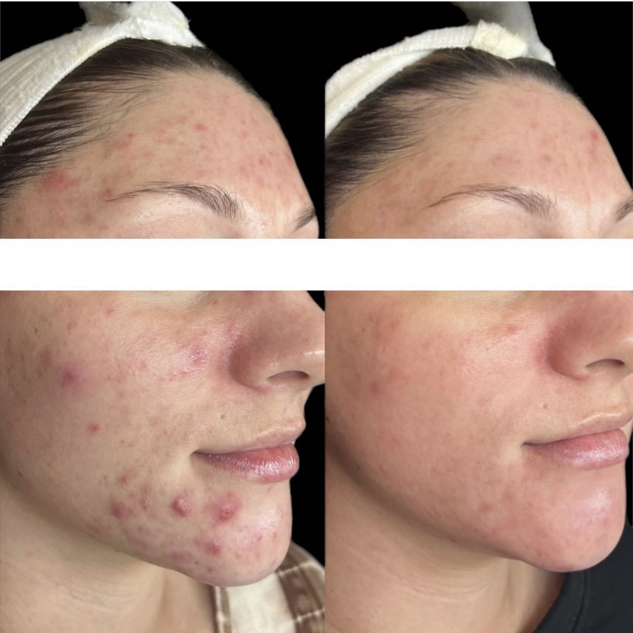 skincara-acne-treatment-knoxville.jpg